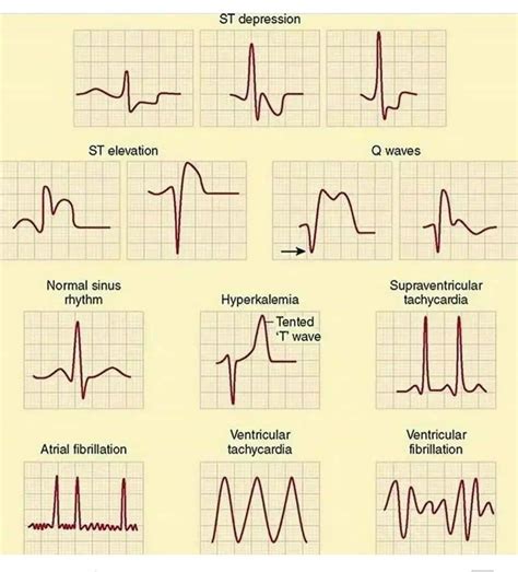 Overview of Abnormal Heart Rhythms .
